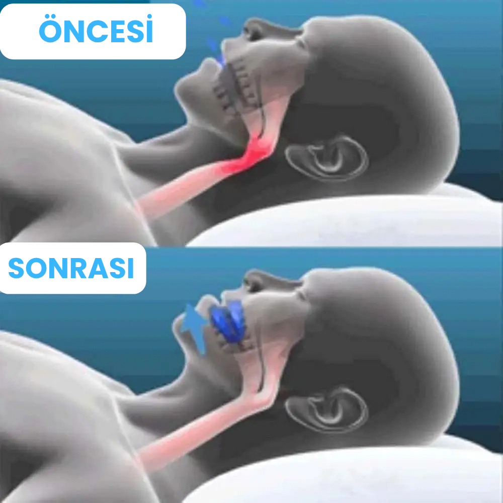 Horlama Önleyici Aparat