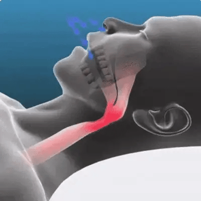 Horlama Önleyici Aparat